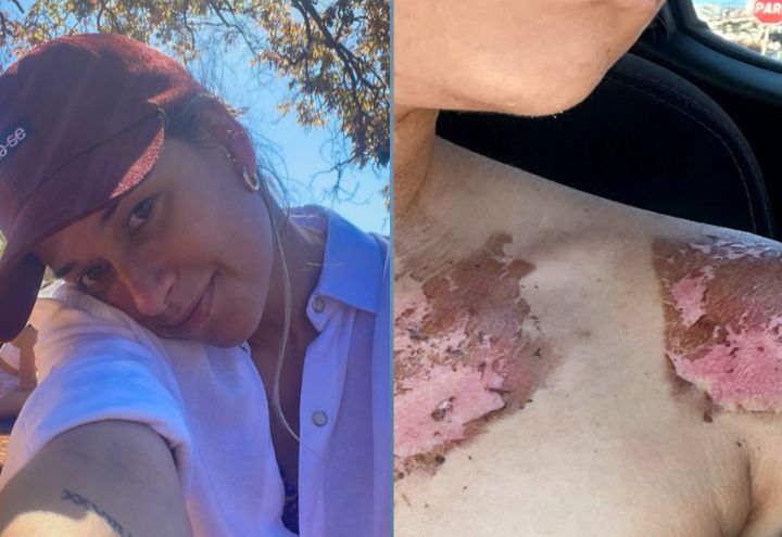 Radiador explode e água deixa queimaduras de 2º grau em jovem
