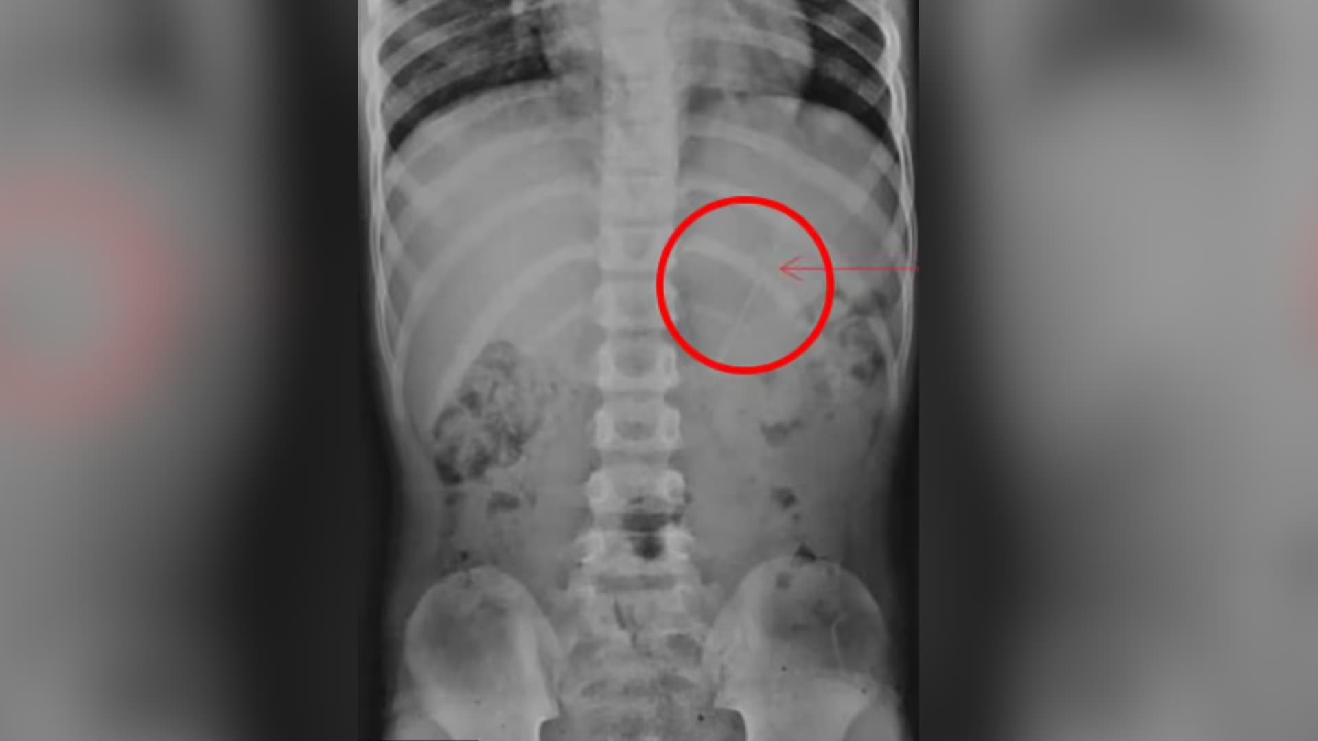 Menino de 7 anos engole lápis inteiro de 10 cm.  | Reprodução/RadiolofyCaseReports