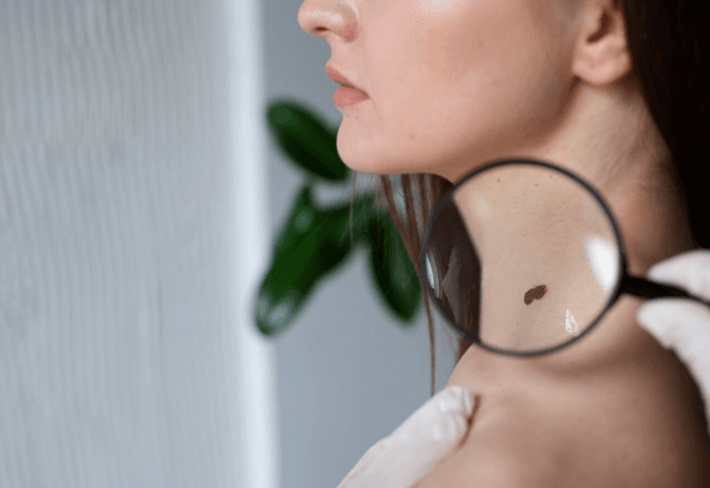 Melanoma apresenta pintas em tons acastanhados ou enegrecidos | Freepik