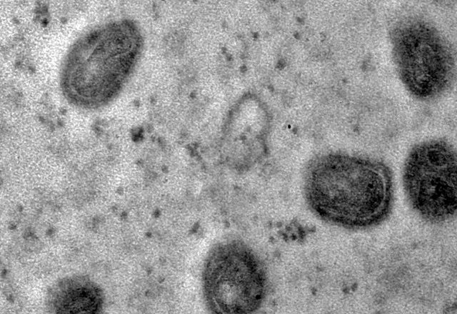 Em geral, os sinais e sintomas incluem erupções cutâneas ou lesões de pele, linfonodos inchados (ínguas), febre, dor de cabeça, dores no corpo, calafrio e fraqueza | Débora F. Barreto-Vieira/IOC/Fiocruz