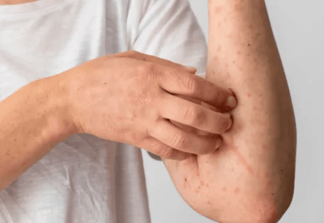Mpox | Reprodução/Freepik