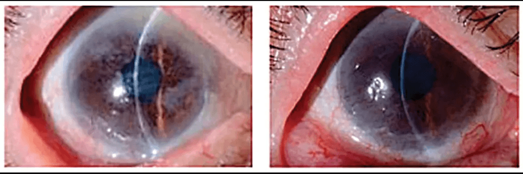 ANTES E DEPOIS - Brilho: após terapia, olho voltou a ficar cristalino (à dir.) (The Lancet/.)