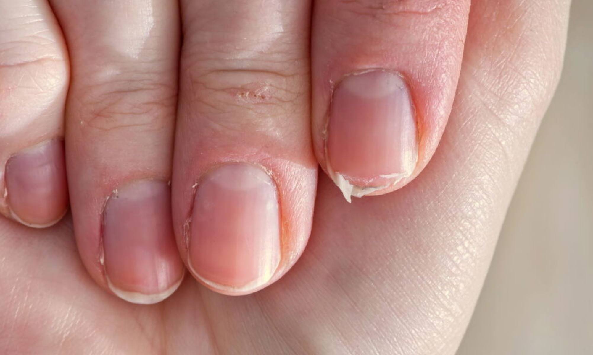 Unhas fracas e quebradiças podem ter soluções simples e contínuas | Foto: Tupi