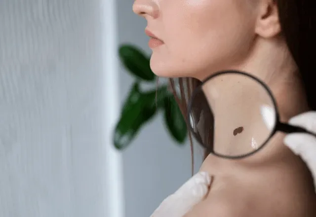 Melanoma apresenta pintas em tons acastanhados ou enegrecidos | Freepik
